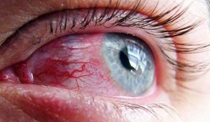 آرایش چشم برای افراد مبتلا به آلرژی و حساسیت